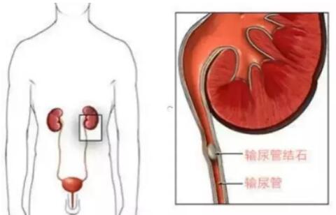 輸尿管結(jié)石，到底能不能保守治療？